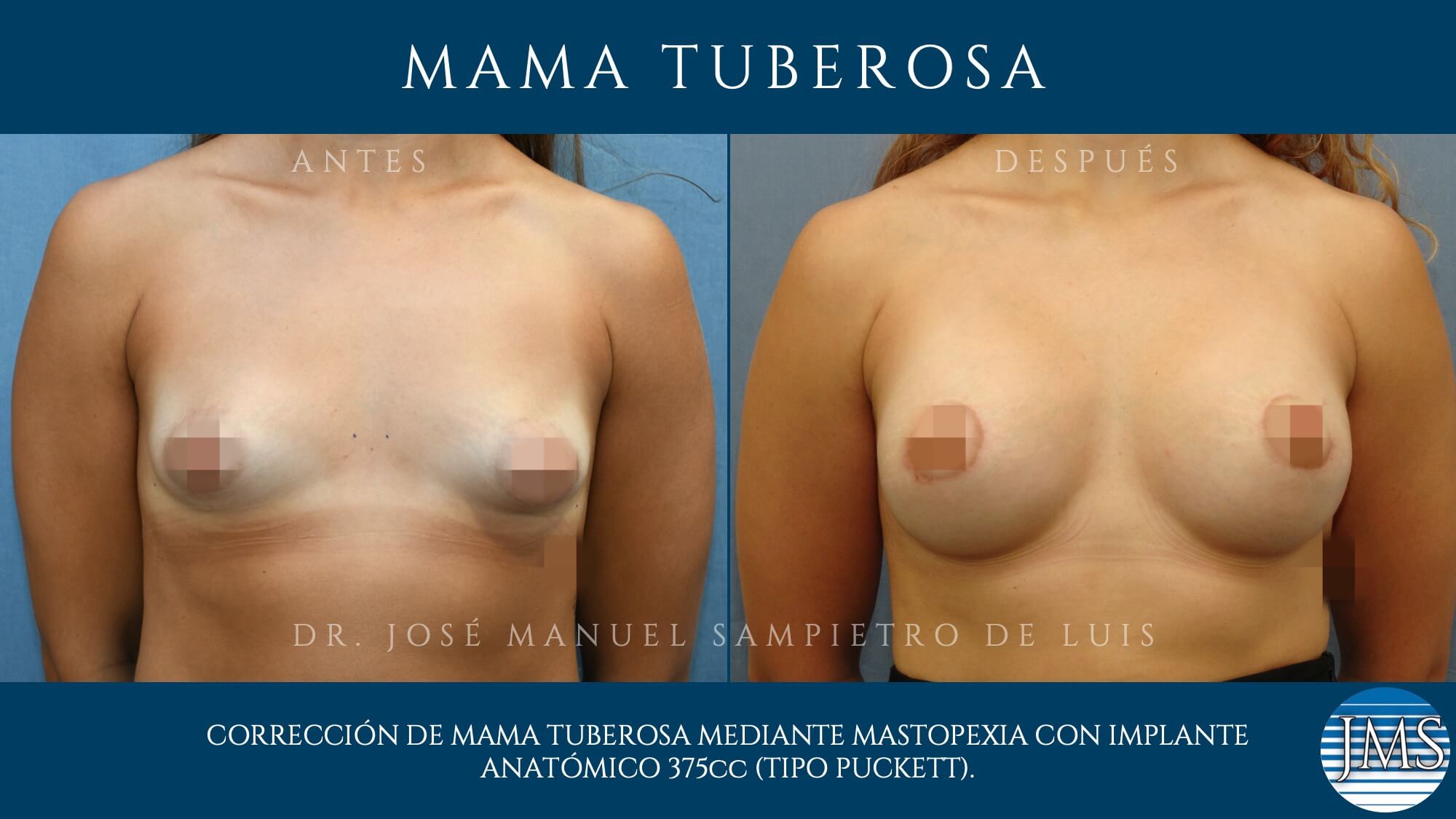 recambio implantes